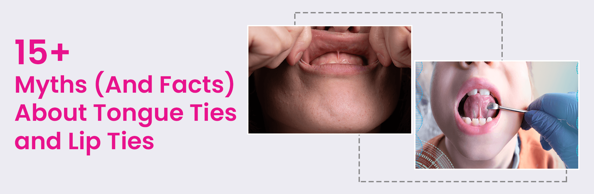 15+ MYTHS (AND FACTS) ABOUT TONGUE TIES AND LIP TIES