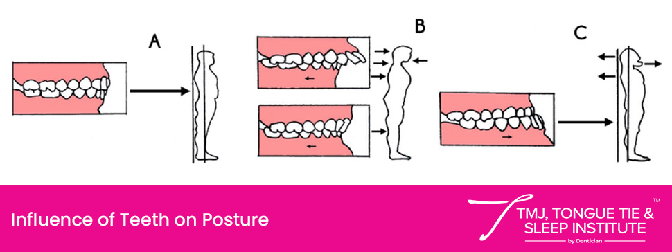Influence of Teeth on Posture