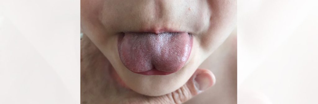 What Exactly Is A Tongue Tie? How Does It Affect Us? | | TMJ, Tongue Tie & Sleep Institute – Tongue Tie Treatment in Mumbai, India | Tongue Tie |