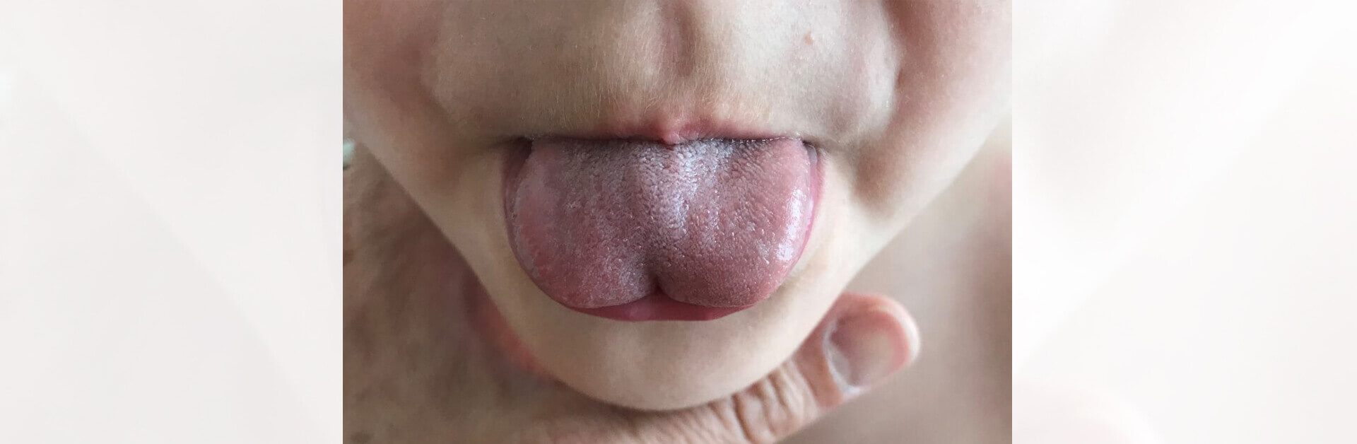 WHAT EXACTLY IS A TONGUE TIE? HOW DOES IT AFFECT US?