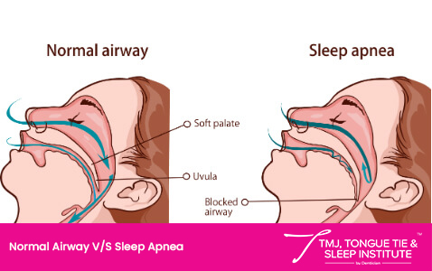 normal airway vs sleep apnea