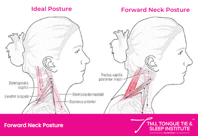 foward neck posture