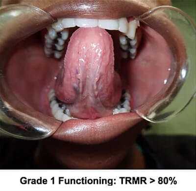 grade 1 functioning trmr