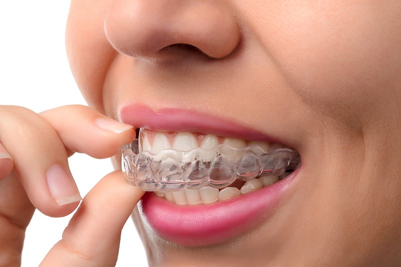 Invisalign