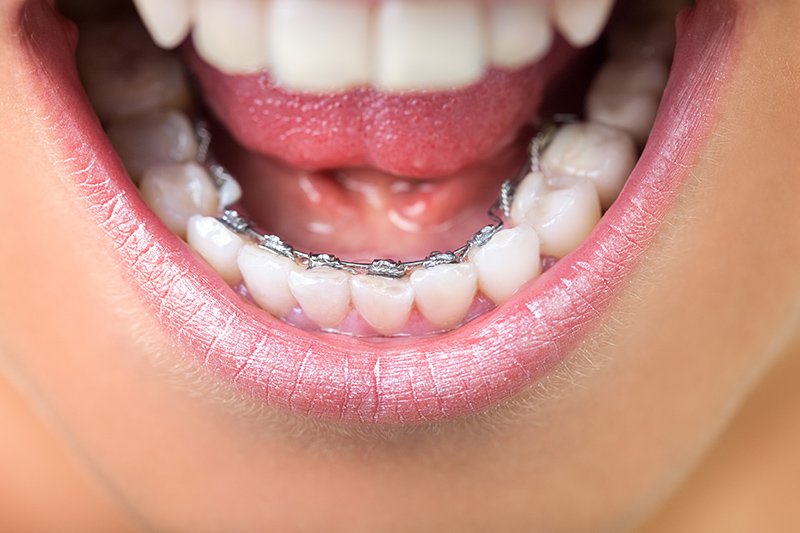 Lingual Braces