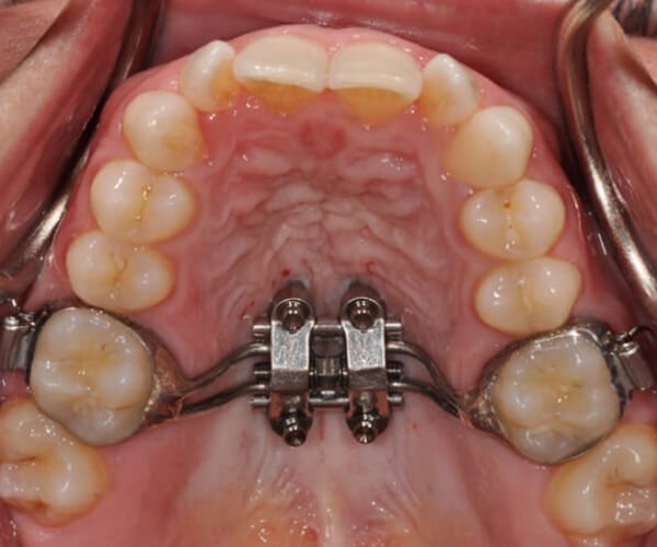 Maxillary skeletal expander