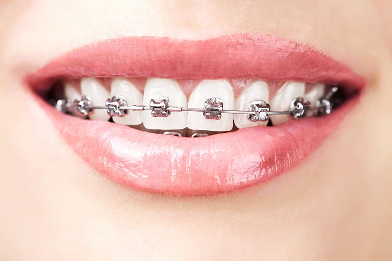 7 Reasons To Get Braces As An Adult | | TMJ, Tongue Tie & Sleep Institute – Tongue Tie Treatment in Mumbai, India | Myofunctional therapy |