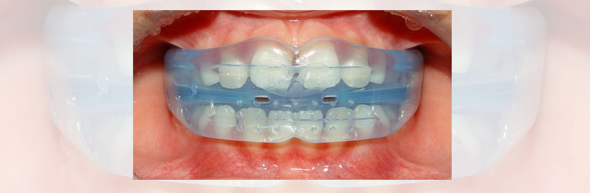 WHAT CAUSES CROOKED TEETH? HOW SOON CAN YOU CORRECT THEM?