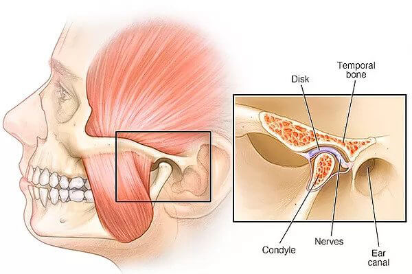 Temporomandibular Joint Disorder