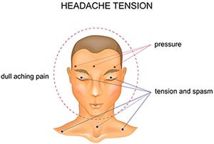 Symptoms of a tension headache