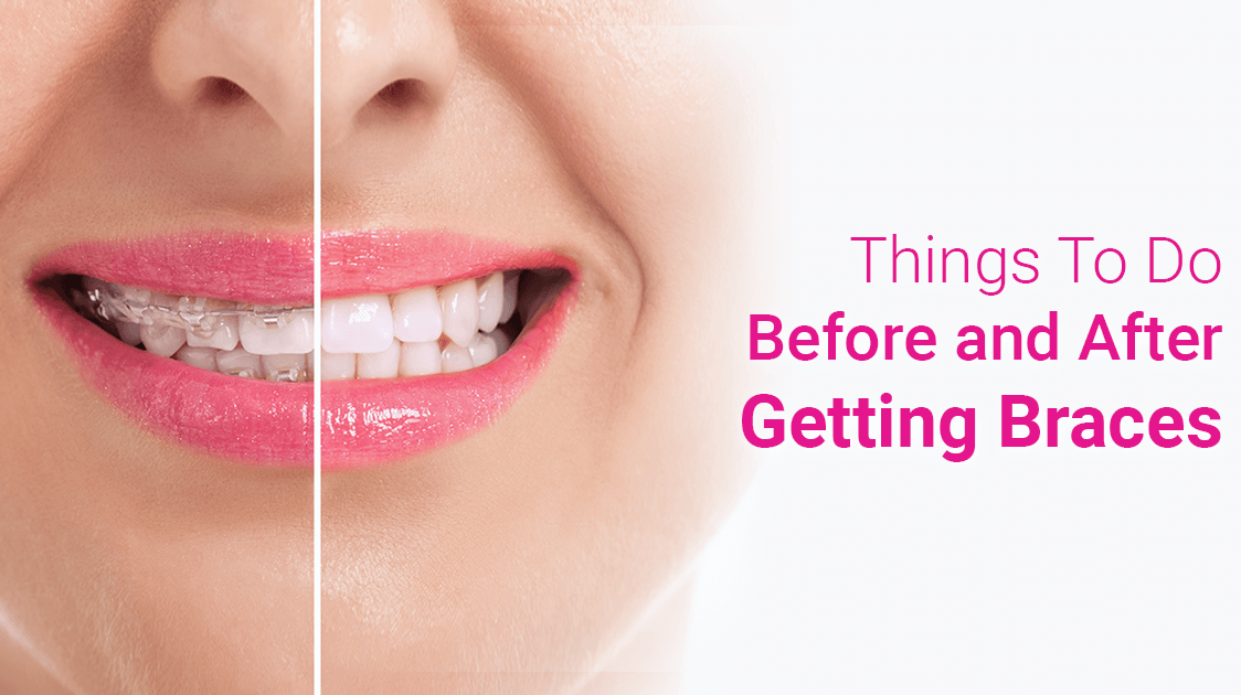THINGS TO DO BEFORE AND AFTER GETTING BRACES