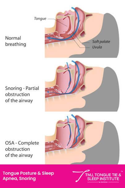 Tongue Posture & obstruction