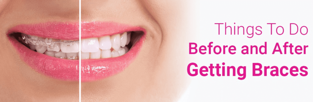Things To Do Before And After Getting Braces - TMJ, Tongue Tie & Sleep ...