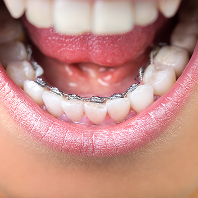 7 Reasons To Get Braces As An Adult | | TMJ, Tongue Tie & Sleep Institute – Tongue Tie Treatment in Mumbai, India | Myofunctional therapy |