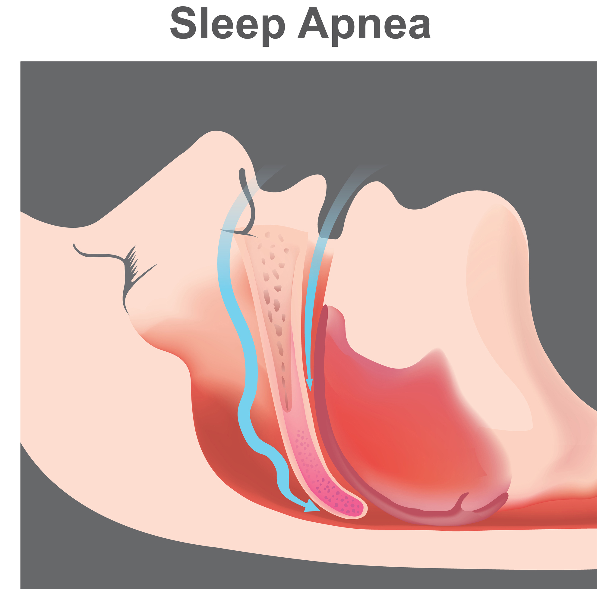 Sleep Apnea Vs Snoring: Understanding the Differences | | TMJ, Tongue Tie & Sleep Institute – Tongue Tie Treatment in Mumbai, India | Sleep |