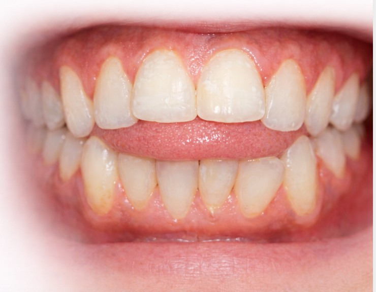 Can Orofacial Myofunctional Therapy Correct Tongue Thrust? | | TMJ, Tongue Tie & Sleep Institute – Tongue Tie Treatment in Mumbai, India | TMJ |