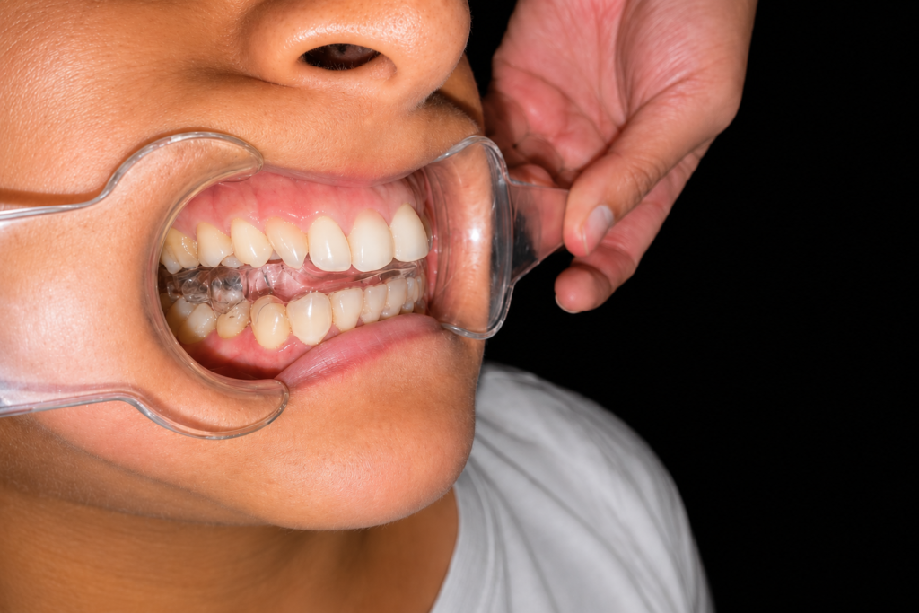 GNM Sleep Appliance: Fix TMJ, Snoring, and Sleep Apnea Holistically | | TMJ, Tongue Tie & Sleep Institute – Tongue Tie Treatment in Mumbai, India | TMJ |
