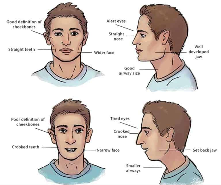 Airway Orthodontic Treatment: Signs, Symptoms & Solutions | | TMJ, Tongue Tie & Sleep Institute – Tongue Tie Treatment in Mumbai, India | TMJ |