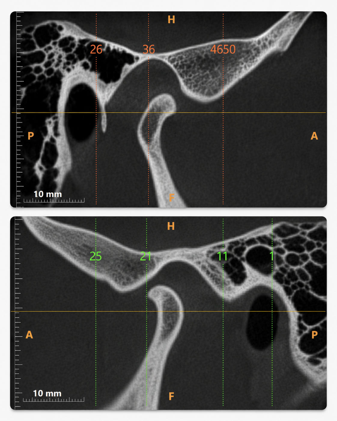 Explain 3D CBCT Scan for TMJ Diagnosis