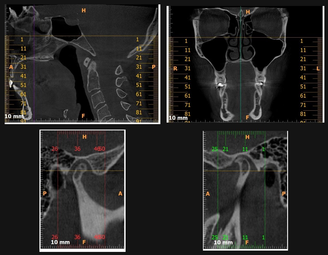 Digital TMJ diagnosis with virtual jaw assessment and CBCT scan review.