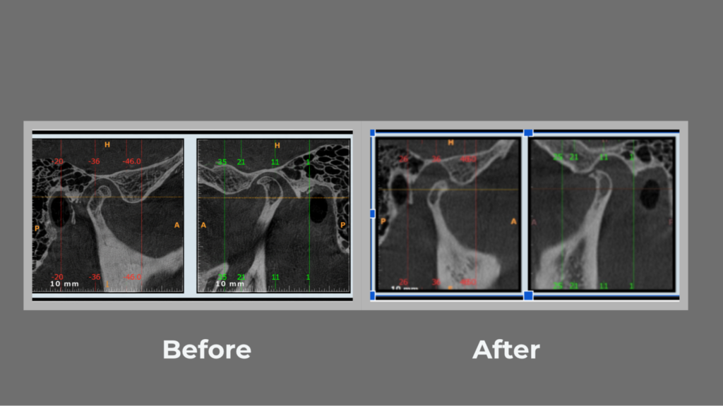CBCT Scans for TMJ Evaluation with before, after Comparison.